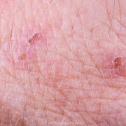 Simulium (Psilopelmia) bicoloratum scratches after some days